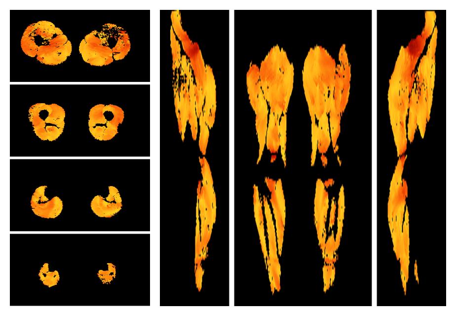 Muscle fiber tract angle map based on whole leg DTI based fiber tractography.