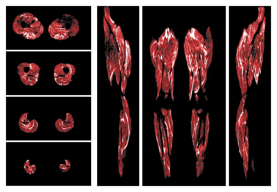 Muscle fiber tract density map based on whole leg DTI based fiber tractography.