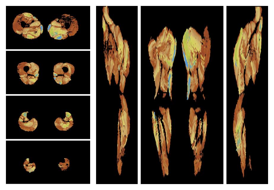 Muscle fiber tract length map based on whole leg DTI based fiber tractography.