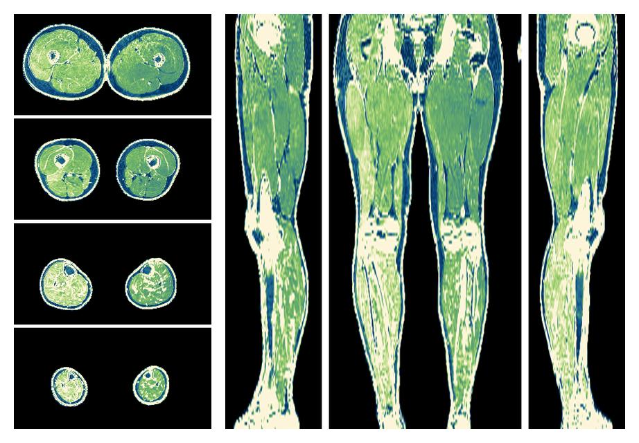 The R2 star relaxation time of the lower extremity obtained from the dixon reconstruction for muscle water fat quantification.