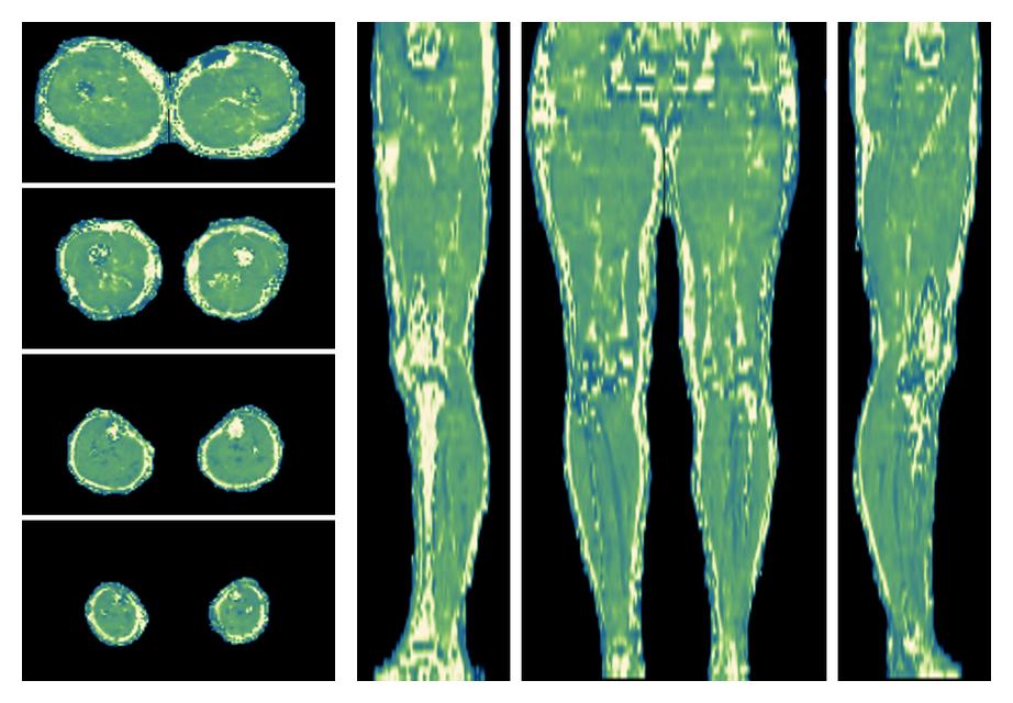 The water only T2 relaxation time of the lower extremity obtained from multi echo spin echo t2 mapping with EPG based reconstruction.