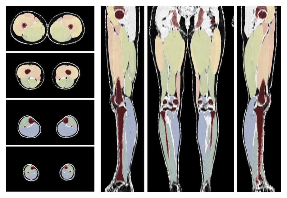 Overlay of automated muscle segmentation labels on dixon water image.