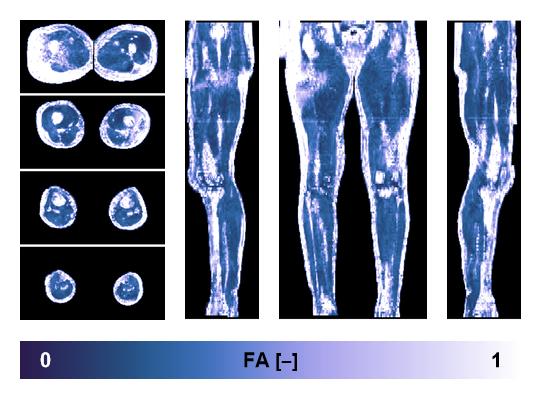 IVIM corrected whole leg muscle fractional anisotropy obtained from diffusion tensor imaging.