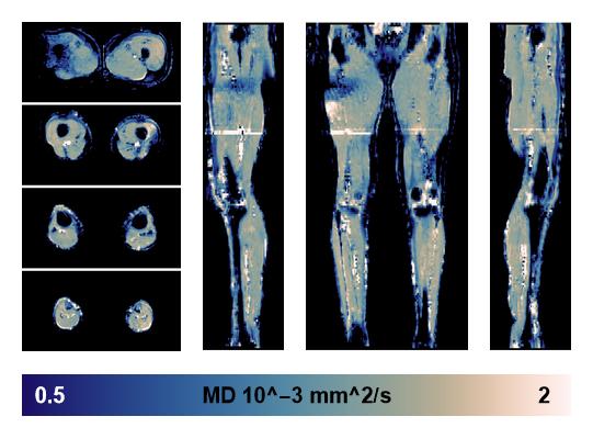 IVIM corrected whole leg muscle mean diffusivity obtained from diffusion tensor imaging.