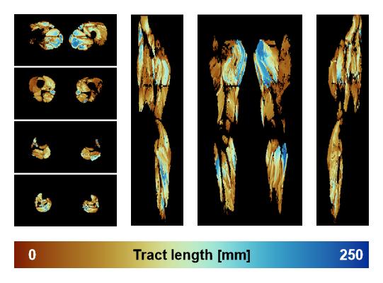 Muscle fiber tract length map based on whole leg DTI based fiber tractography.