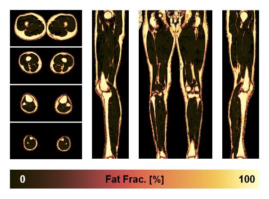 The fat fraction of the lower extremity obtained from the dixon reconstruction for muscle water fat quantification.