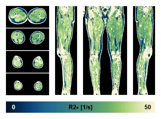 The R2 star relaxation time of the lower extremity obtained from the dixon reconstruction for muscle water fat quantification.