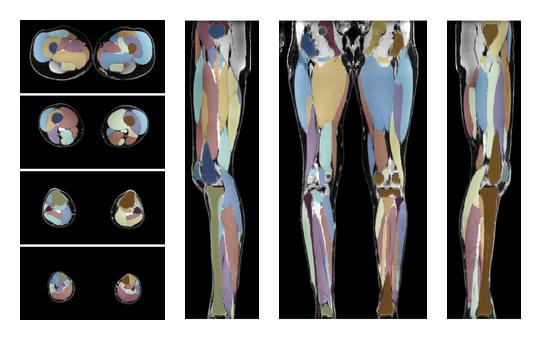 Overlay of automated muscle segmentation labels on dixon water image.