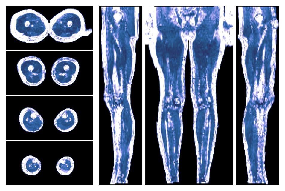 IVIM corrected whole leg muscle fractional anisotropy obtained from diffusion tensor imaging.