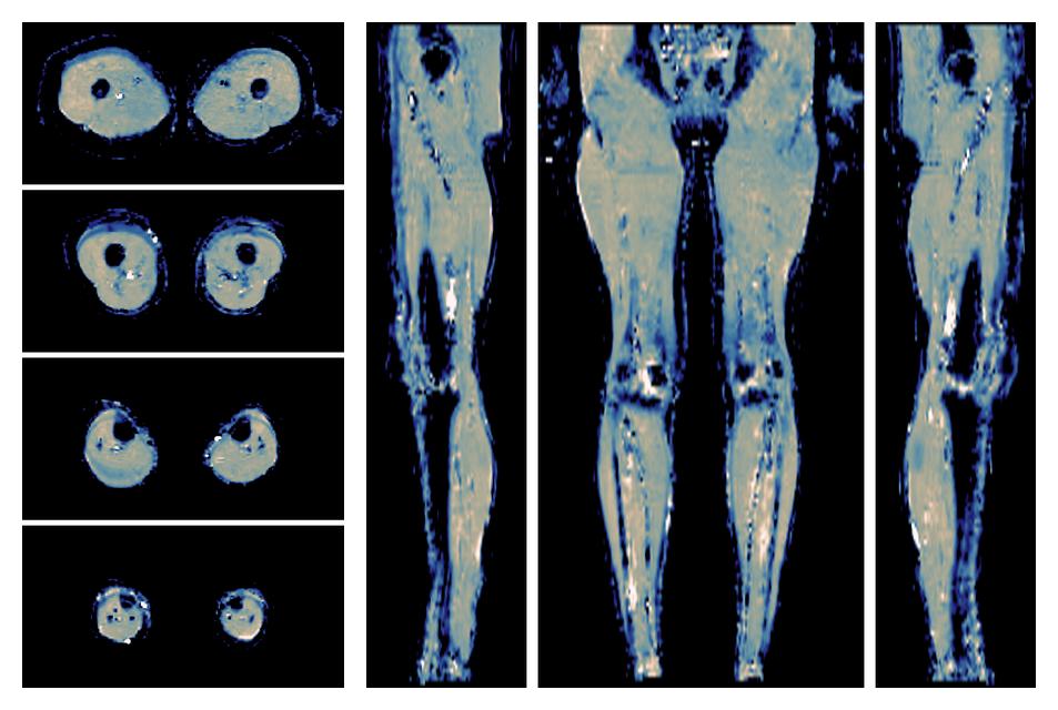 IVIM corrected whole leg muscle mean diffusivity obtained from diffusion tensor imaging.