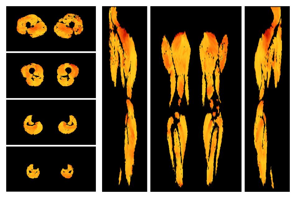 Muscle fiber tract angle map based on whole leg DTI based fiber tractography.