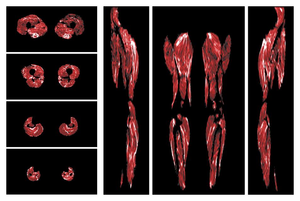 Muscle fiber tract density map based on whole leg DTI based fiber tractography.