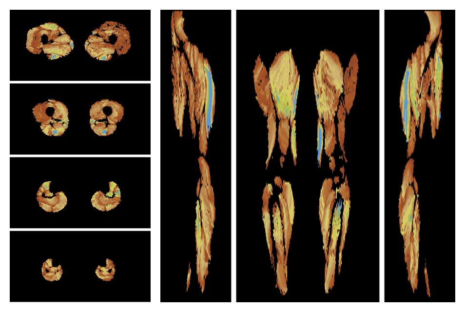 Muscle fiber tract length map based on whole leg DTI based fiber tractography.