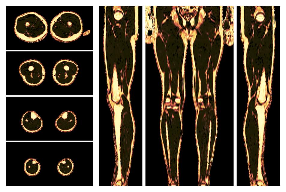 The fat fraction of the lower extremity obtained from the dixon reconstruction for muscle water fat quantification.