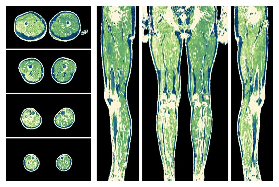 The R2 star relaxation time of the lower extremity obtained from the dixon reconstruction for muscle water fat quantification.