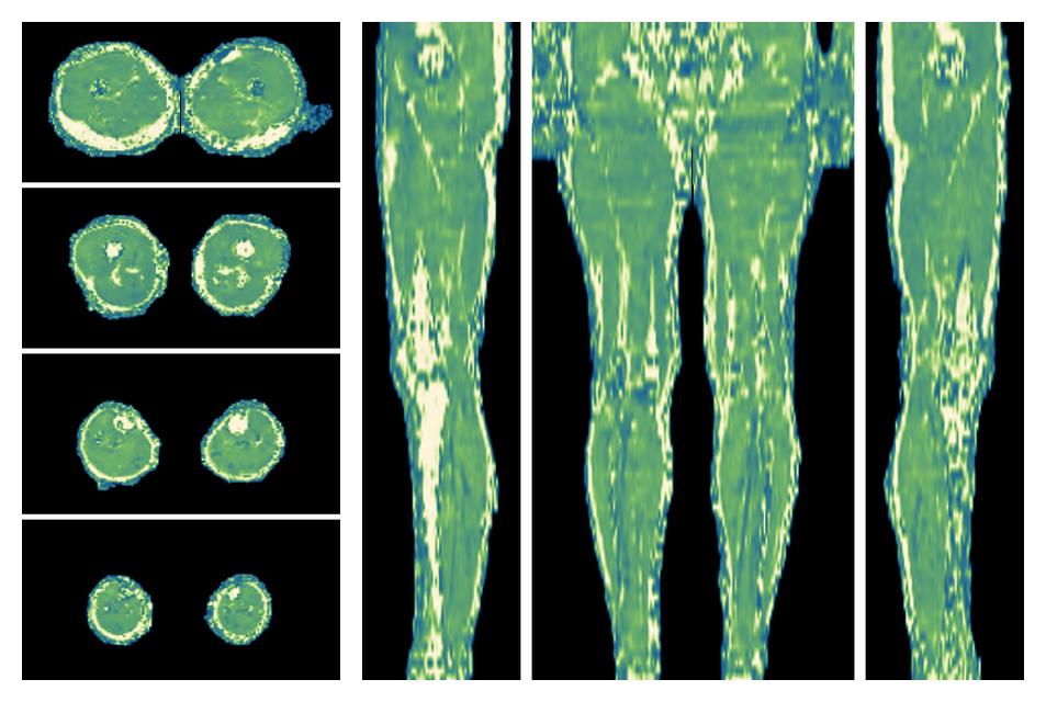 The water only T2 relaxation time of the lower extremity obtained from multi echo spin echo t2 mapping with EPG based reconstruction.