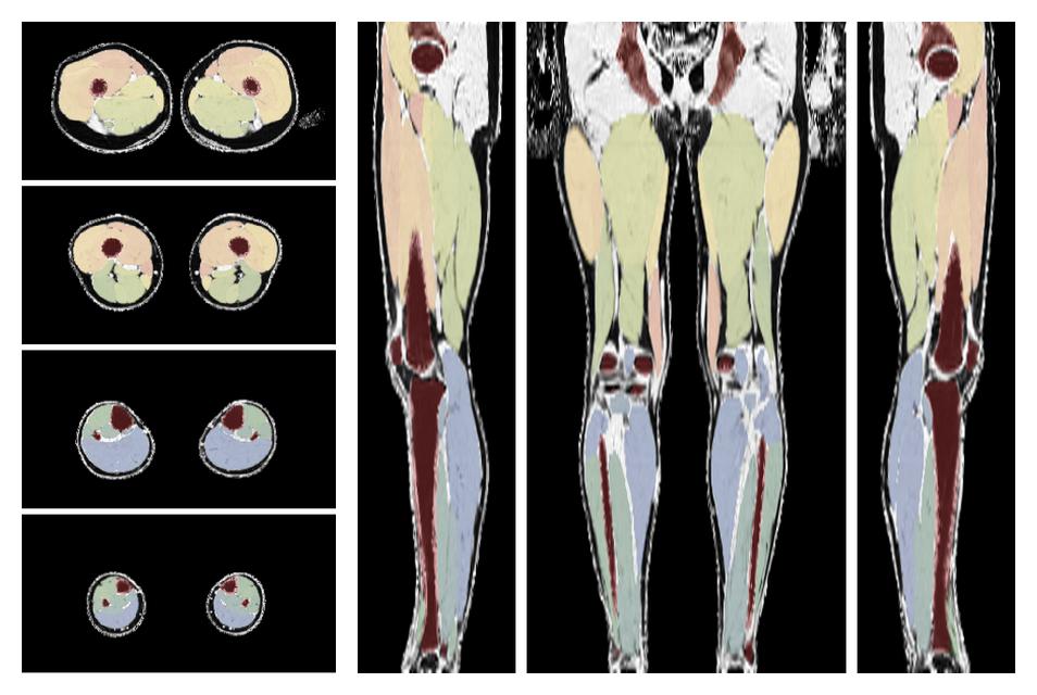 Overlay of automated muscle segmentation labels on dixon water image.