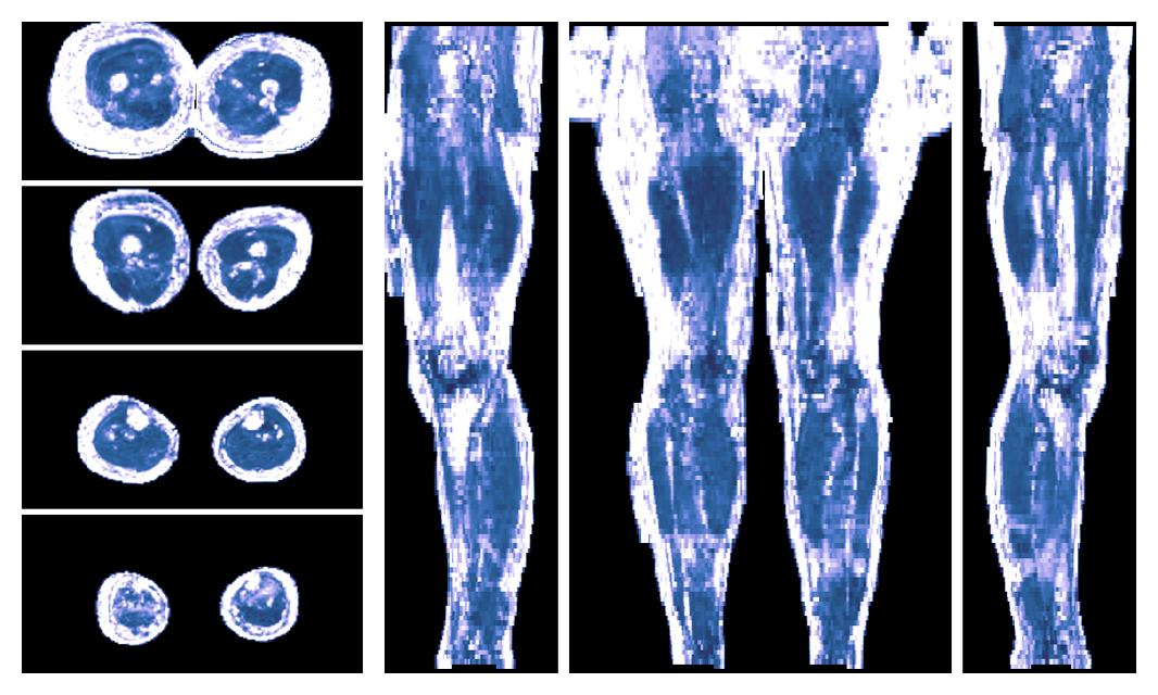 IVIM corrected whole leg muscle fractional anisotropy obtained from diffusion tensor imaging.