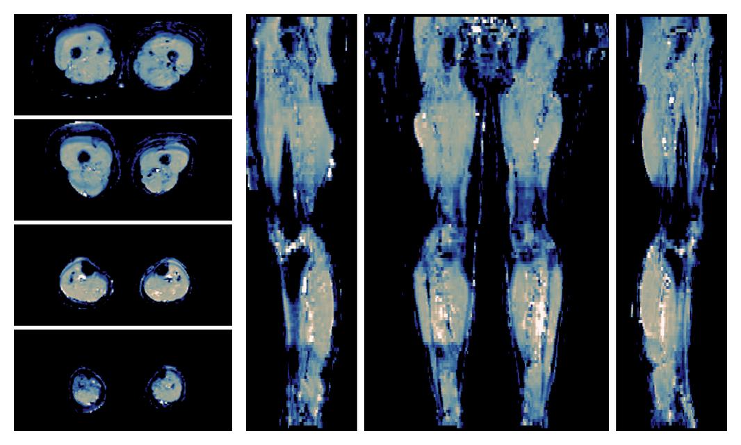 IVIM corrected whole leg muscle mean diffusivity obtained from diffusion tensor imaging.