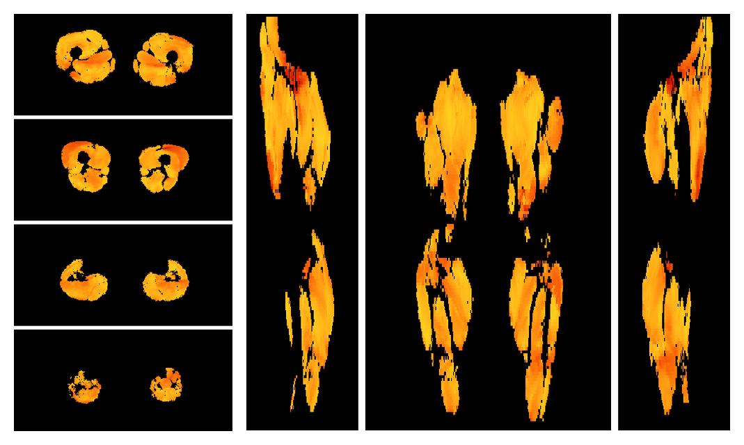 Muscle fiber tract angle map based on whole leg DTI based fiber tractography.