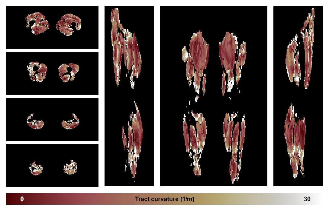 Muscle fiber tract curvature map based on whole leg DTI based fiber tractography.