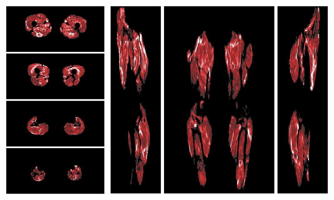 Muscle fiber tract density map based on whole leg DTI based fiber tractography.