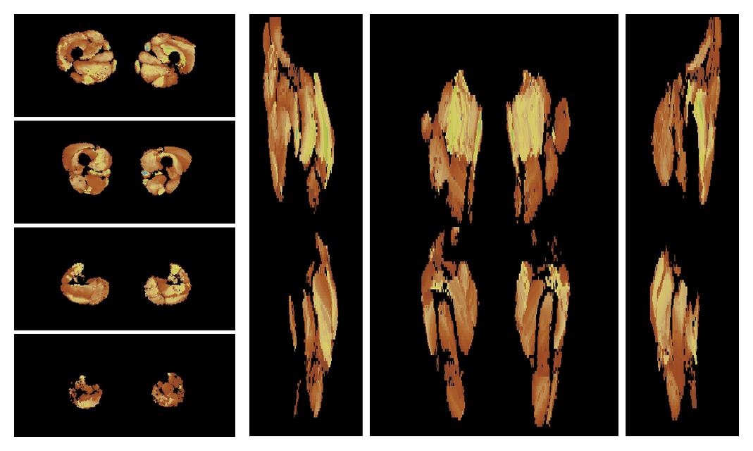 Muscle fiber tract length map based on whole leg DTI based fiber tractography.