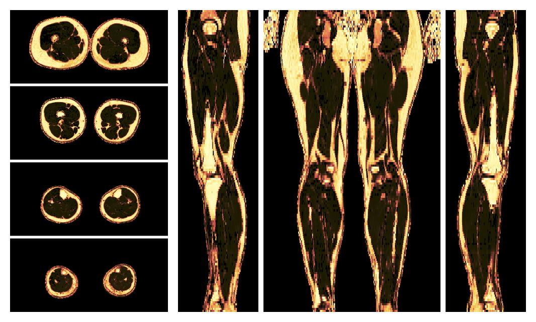 The fat fraction of the lower extremity obtained from the dixon reconstruction for muscle water fat quantification.