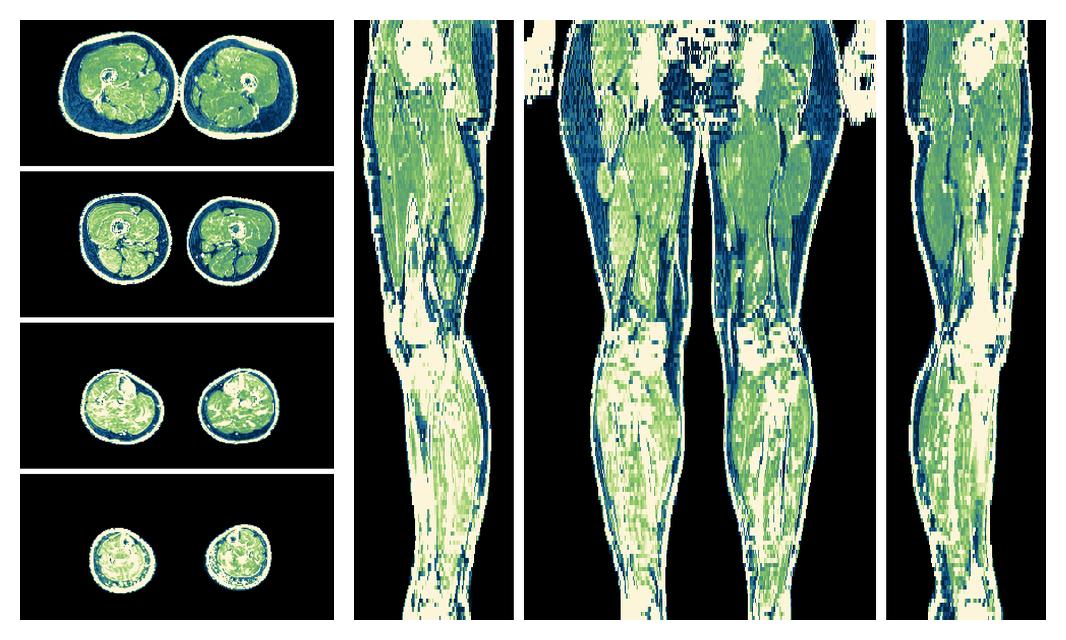 The R2 star relaxation time of the lower extremity obtained from the dixon reconstruction for muscle water fat quantification.