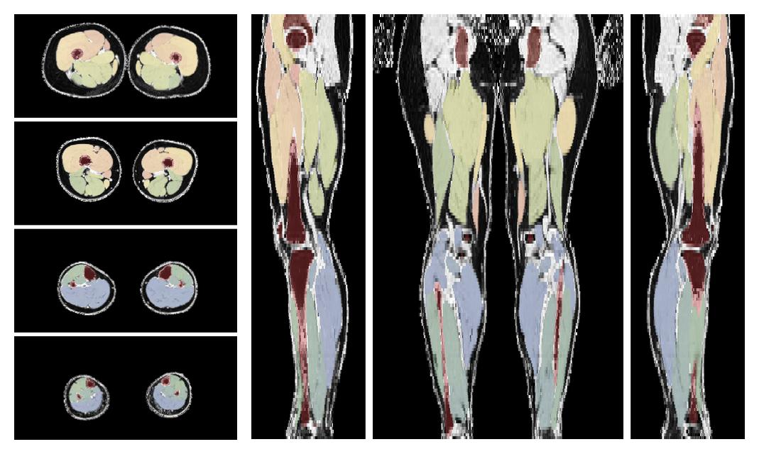 Overlay of automated muscle segmentation labels on dixon water image.