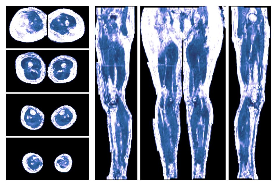 IVIM corrected whole leg muscle fractional anisotropy obtained from diffusion tensor imaging.