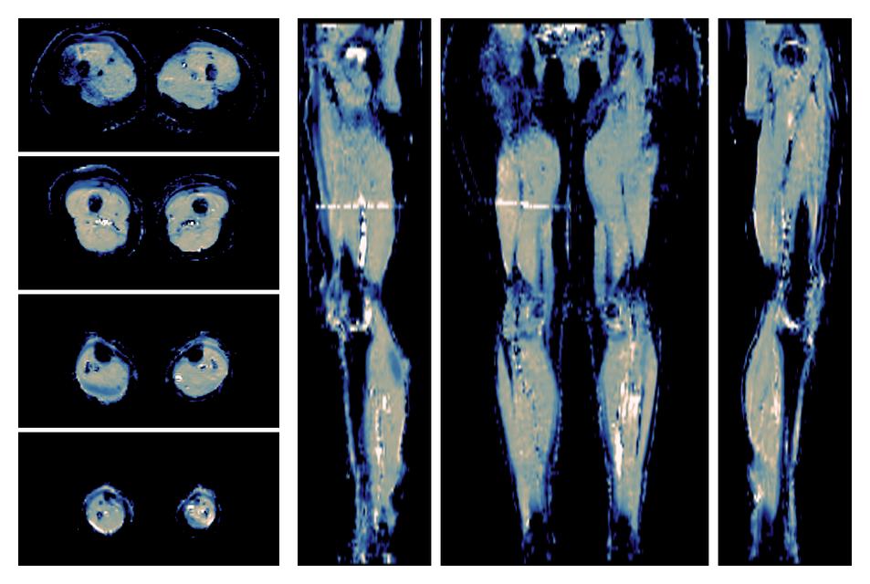 IVIM corrected whole leg muscle mean diffusivity obtained from diffusion tensor imaging.