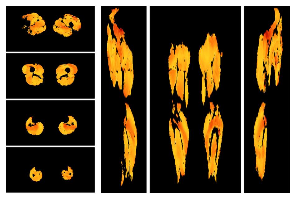 Muscle fiber tract angle map based on whole leg DTI based fiber tractography.