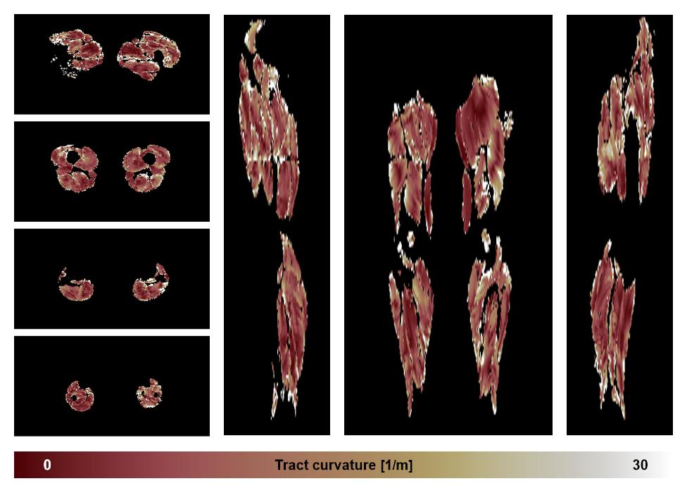 Muscle fiber tract curvature map based on whole leg DTI based fiber tractography.