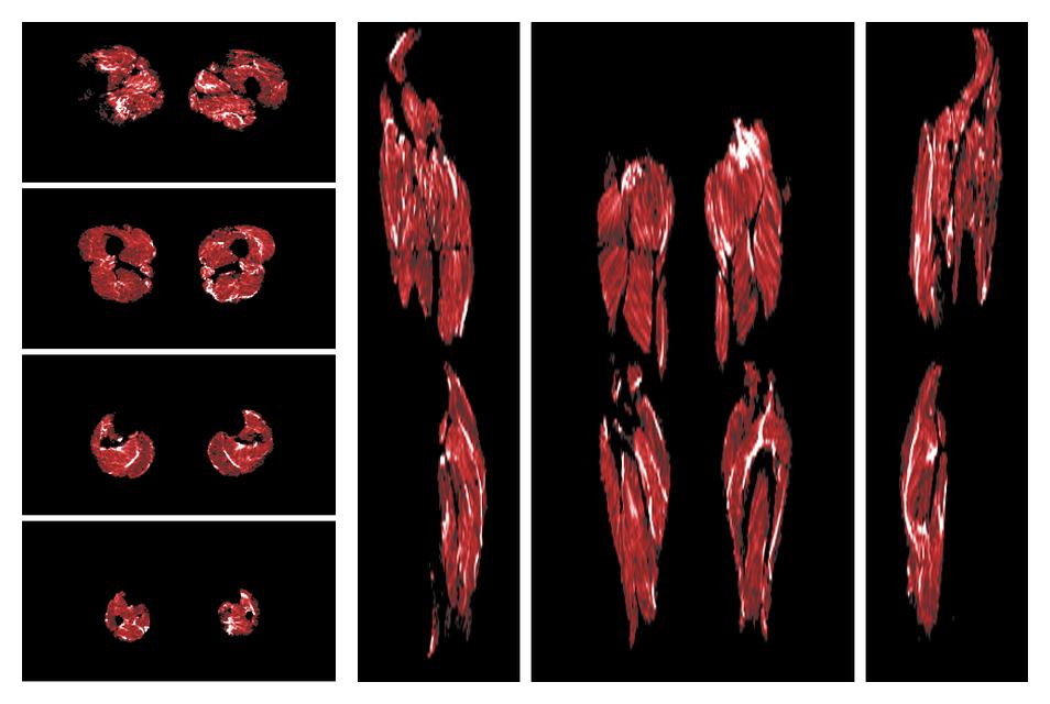 Muscle fiber tract density map based on whole leg DTI based fiber tractography.