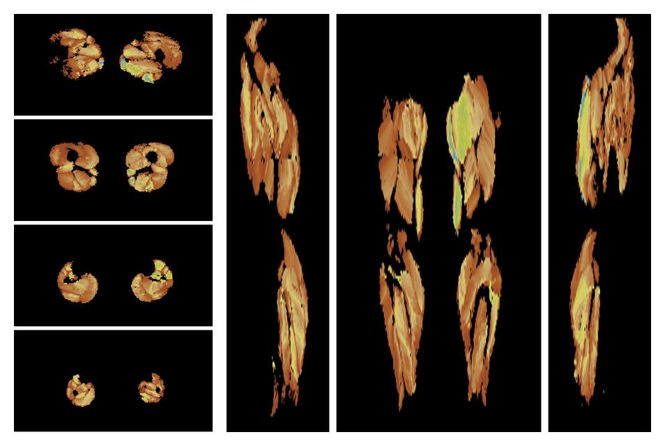 Muscle fiber tract length map based on whole leg DTI based fiber tractography.