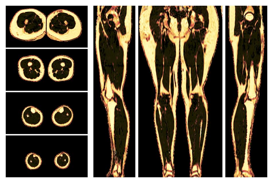 The fat fraction of the lower extremity obtained from the dixon reconstruction for muscle water fat quantification.