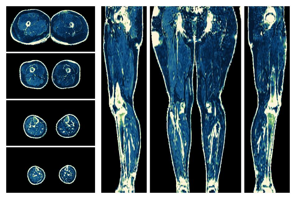 The R2 star relaxation time of the lower extremity obtained from the dixon reconstruction for muscle water fat quantification.