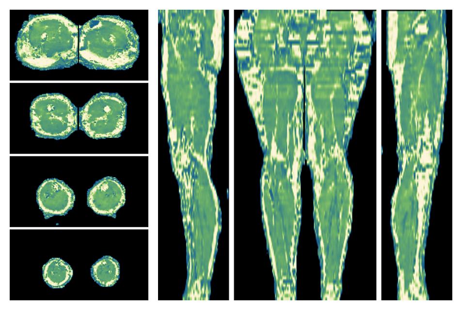 The water only T2 relaxation time of the lower extremity obtained from multi echo spin echo t2 mapping with EPG based reconstruction.