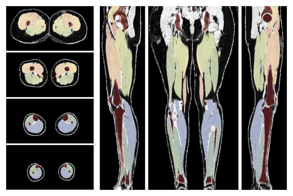 Overlay of automated muscle segmentation labels on dixon water image.