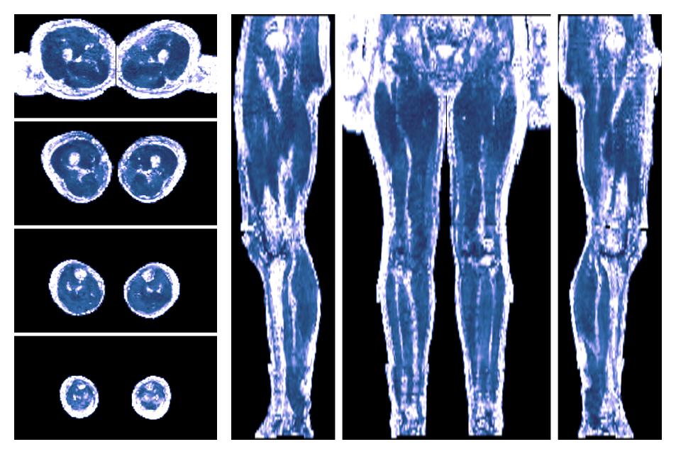 IVIM corrected whole leg muscle fractional anisotropy obtained from diffusion tensor imaging.