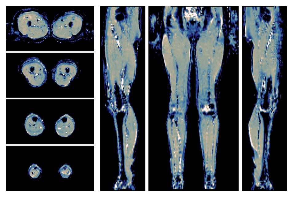 IVIM corrected whole leg muscle mean diffusivity obtained from diffusion tensor imaging.