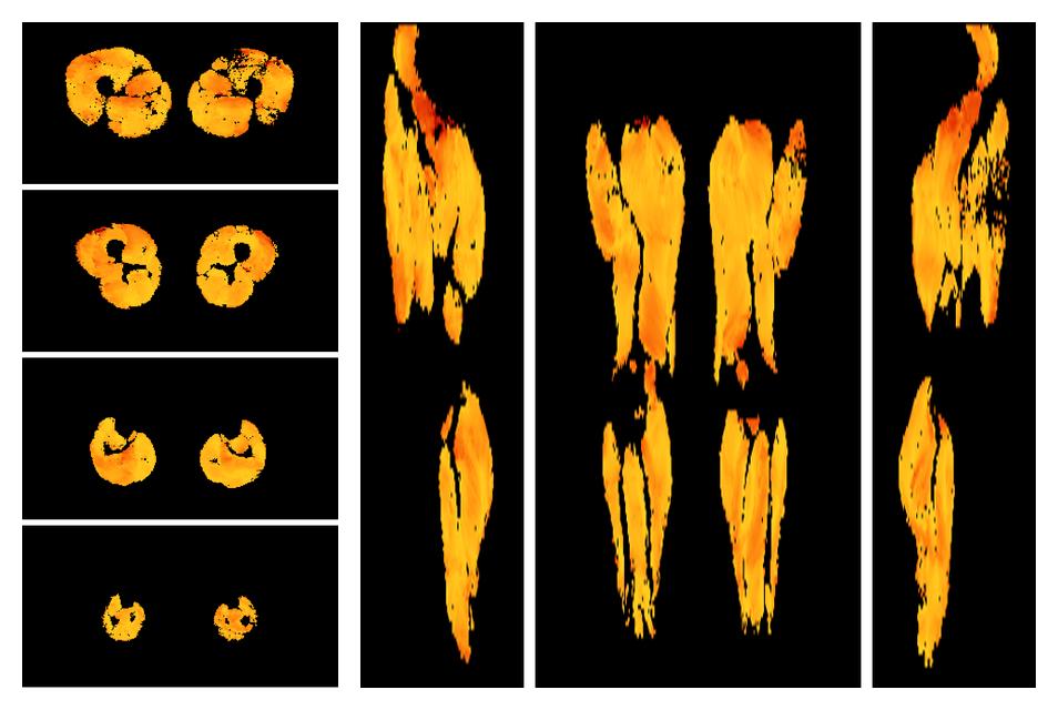 Muscle fiber tract angle map based on whole leg DTI based fiber tractography.