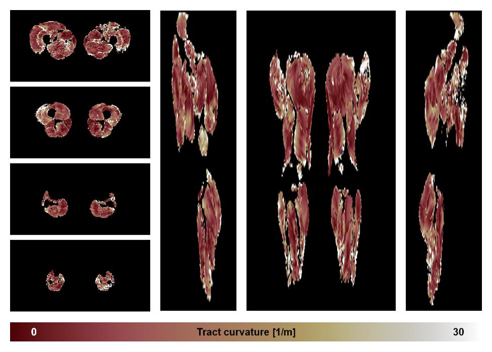 Muscle fiber tract curvature map based on whole leg DTI based fiber tractography.