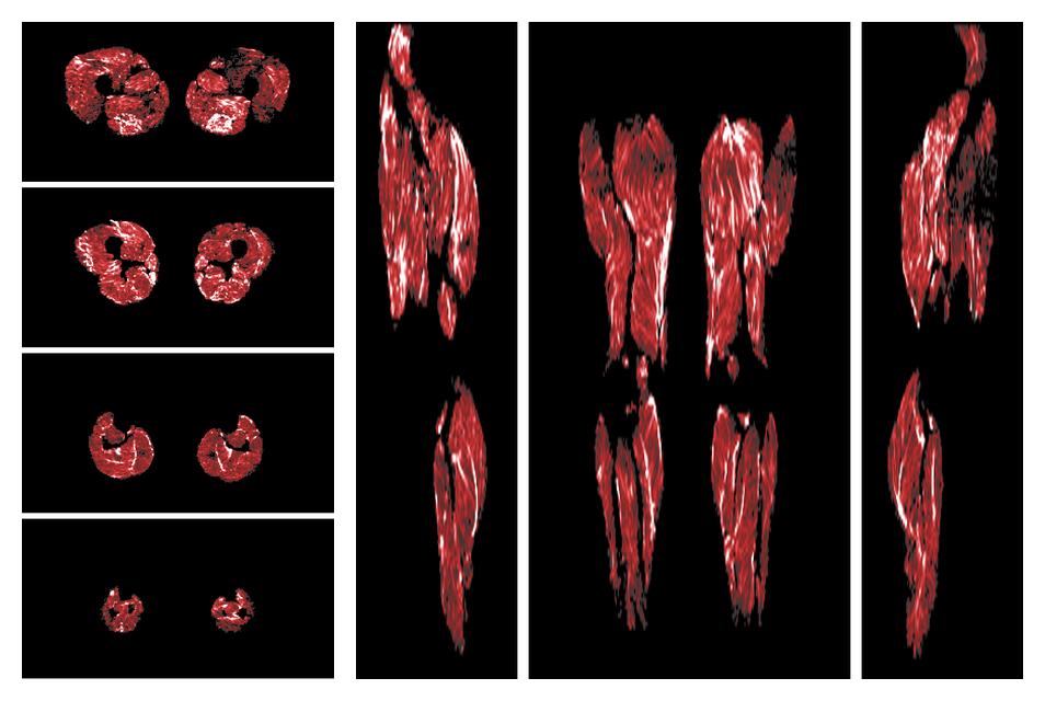 Muscle fiber tract density map based on whole leg DTI based fiber tractography.