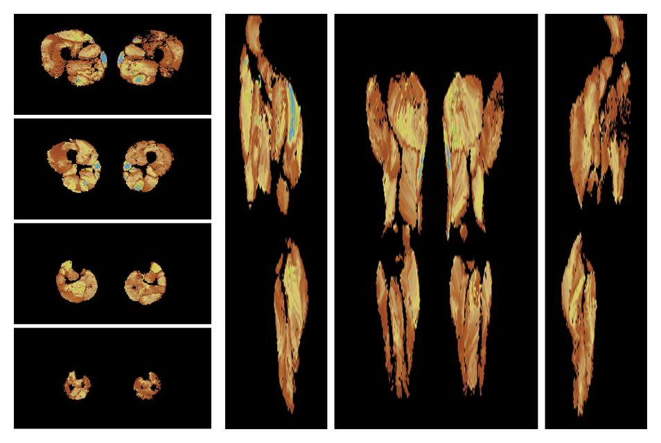 Muscle fiber tract length map based on whole leg DTI based fiber tractography.