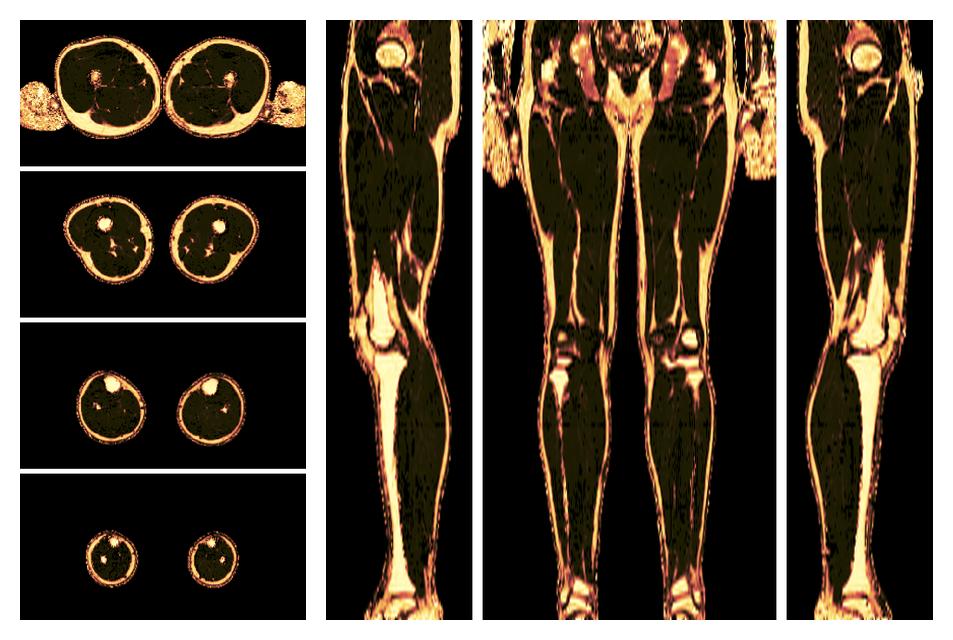 The fat fraction of the lower extremity obtained from the dixon reconstruction for muscle water fat quantification.