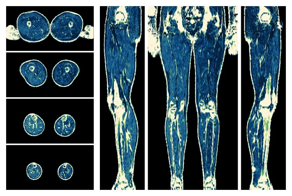 The R2 star relaxation time of the lower extremity obtained from the dixon reconstruction for muscle water fat quantification.