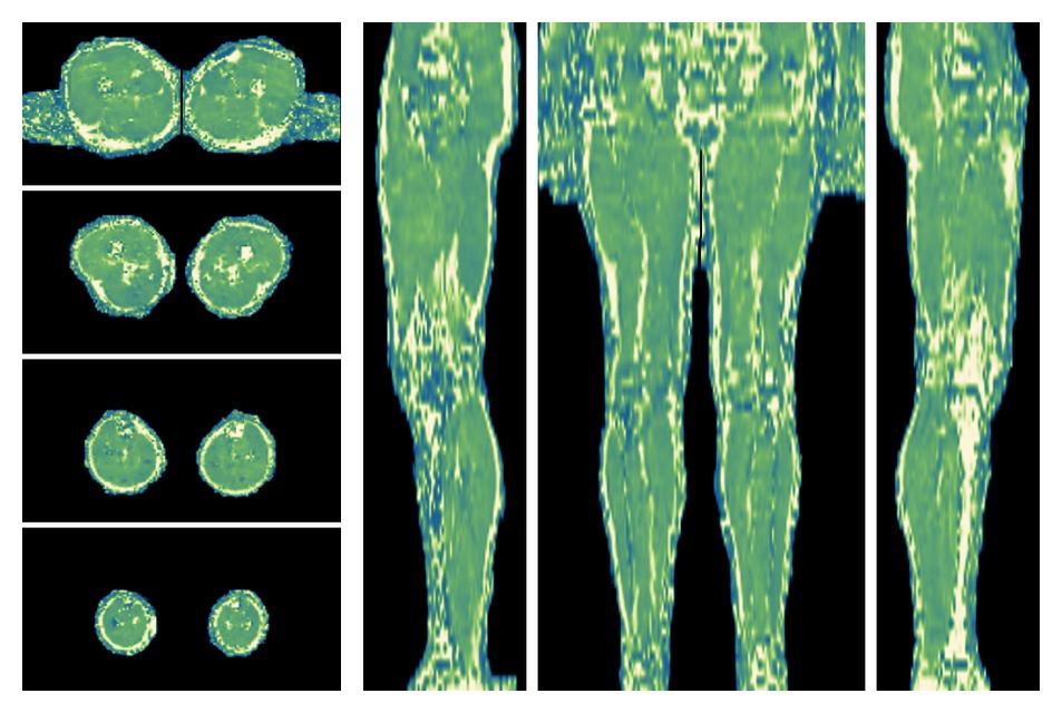 The water only T2 relaxation time of the lower extremity obtained from multi echo spin echo t2 mapping with EPG based reconstruction.