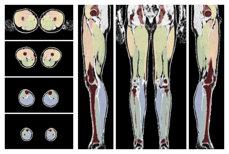 Overlay of automated muscle segmentation labels on dixon water image.